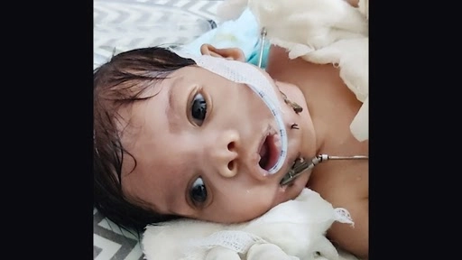 Lucknow: Command Hospital Performs Miraculous Surgery on New Born Child Suffering From Rare Pierre Robin Sequence Disorder