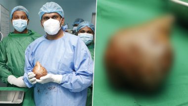 World's Largest and Heaviest Kidney Stone Removed From Patient in Sri Lanka: Sri Lankan Doctors Remove Grapefruit-Sized Kidney Stone Weighing 800 Grams From Retired Soldier (See Pics and Video)