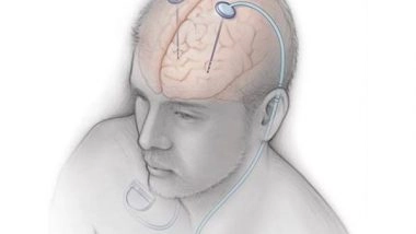 India News | Doctors of Ganga Ram Hospital Performs Rare Surgery for Patient Suffering from Parkinson