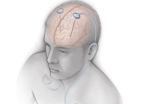 India News | Doctors of Ganga Ram Hospital Performs Rare Surgery for Patient Suffering from Parkinson