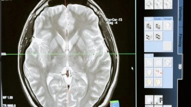 Science News | Study Identifies Brain Network Connections Associated with Anosognosia