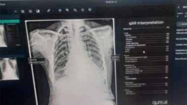 India News | District Hospital Shopian Becomes First in Kashmir Division to Introduce AI in Radio Diagnosis