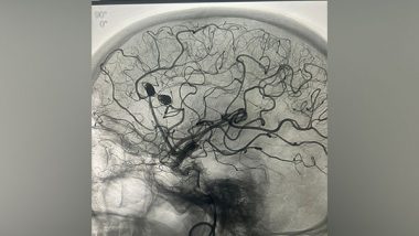 Business News | Jaipur's Eternal Hospital Rare Feat in Neurointervention - Endovascular Coiling in Cathlab, Treating Multiple Ruptured Distal ACA Aneurysms