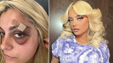 Bebe Rexha Shares Pic of Her ‘Black and Blue’ Eye Post Assault by Concertgoer During NYC Show