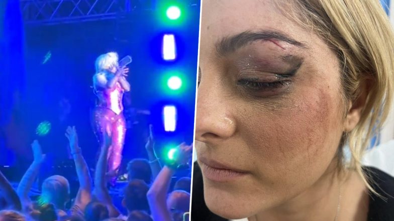 Singer Bebe Rexha Shows Her Injured Face on TikTok After Being Hit by Cell Phone During NYC Concert (Watch Video)