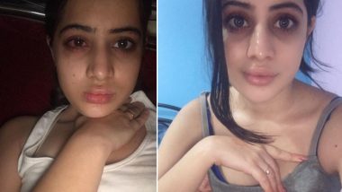 Uorfi Javed Shares Her Lip Filler Journey, Admits to Botched Surgeries (View Pics)