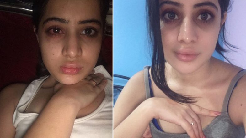 Uorfi Javed Shares Her Lip Filler Journey, Admits to Botched Surgeries (View Pics)