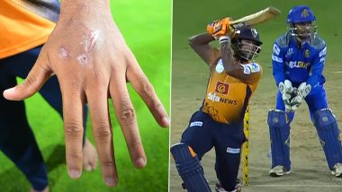 After Getting Eight Stitches in Hand Nidhish Rajagopal Smashes 76 Runs During TNPL 2023 Match (Watch Video)