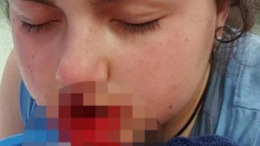 American Bulldog Bites 12-Year-Old Girl in Australia As She Leans In To Kiss Him