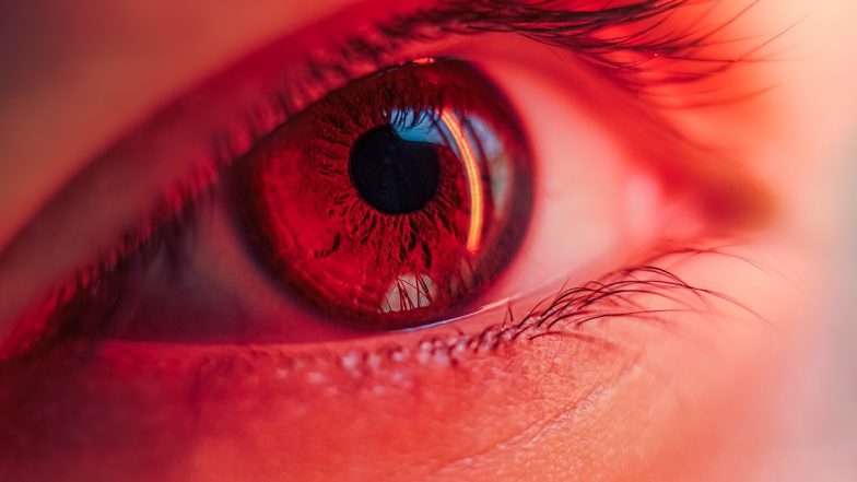 Conjunctivitis Outbreak in Arunachal Pradesh: Schools in Several Districts Closed Temporarily Due Spread of Pink Eye Infection