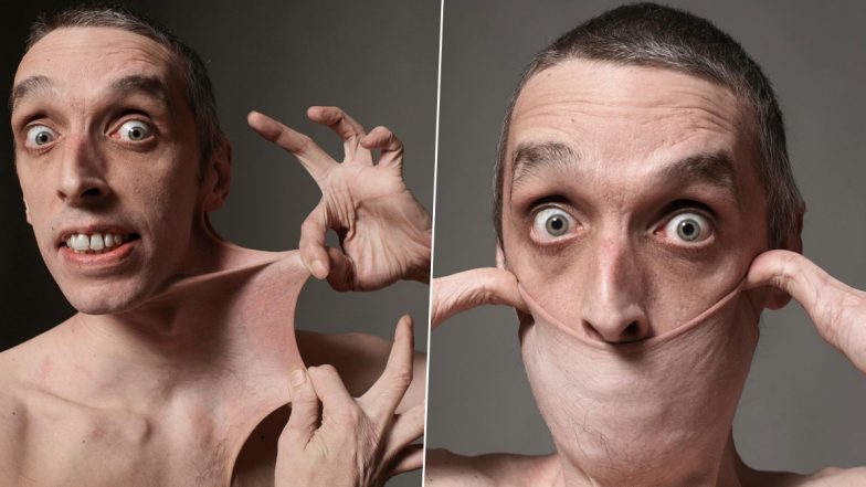 Gary Turner Can Stretch His Skin to a Length of 15.8 cm, Holds the Guinness World Record for Stretchiest Skin Since 1999 (See Pics)