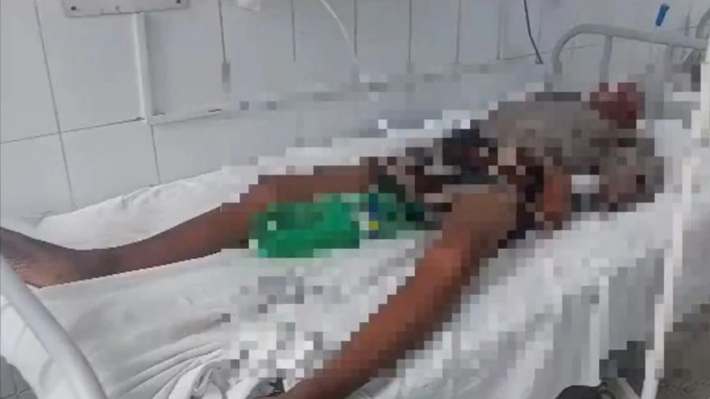 Bihar Shocker: Hospital Uses Cold Drink Bottle Instead of Urine Bag for Patient Amid Lack of Medical Supplies in Jamui, Video Surfaces