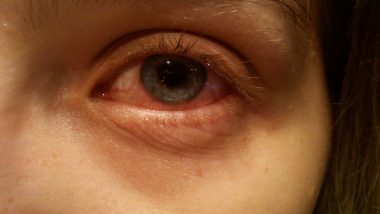 Conjunctivitis Eye Infection Causes, Precautions & Treatment: What Is Pink Eye? Everything You Need To Know About Conjunctiva Inflammation