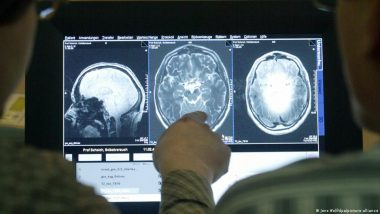 Alzheimer: Mystery of Dying Brain Cells Solved