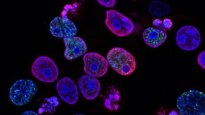 AI For Cancer Treatment: Microsoft, Paige To Build World’s Largest Image-Based Artificial Intelligence Models To Fight Cancer