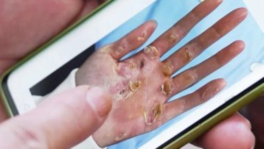 Picture of Asian Games 2023 Rowing Champion’s Blistered Hand Goes Viral