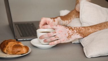 Patients With Psoriasis Have Lower Coronary Flow, Reveals Study