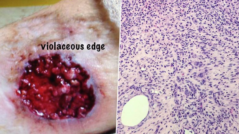 UK Woman Suffers From Rare Condition Where Her Skin 'Eats Itself', Narrates Her Ordeal of Painful Days After Treatment