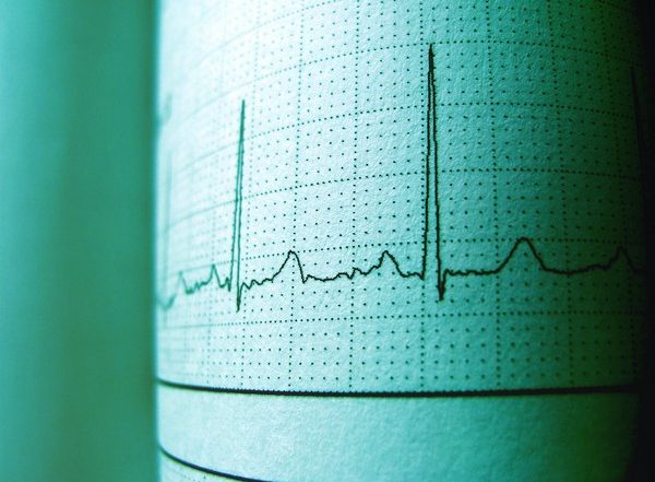 Science News | Study Uses AI to Identify People with Irregular Heartbeats