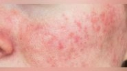 India News | Cases of Skin Disease Psoriasis on the Rise in India, Doctors Warn of Increased Risk in Winter