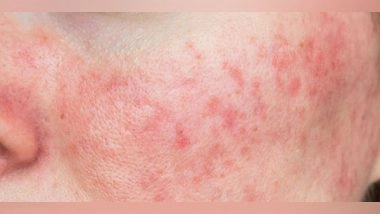 India News | Cases of Skin Disease Psoriasis on the Rise in India, Doctors Warn of Increased Risk in Winter