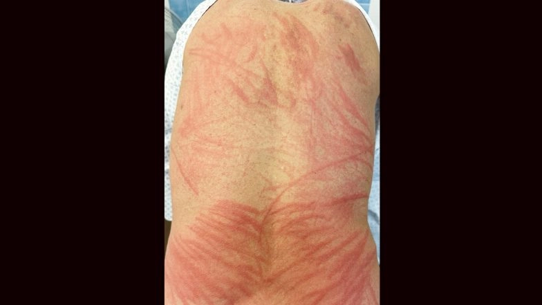 Switzerland: Man Suffers From Shiitake Dermatitis After Consuming Undercooked Mushrooms, Know Everything About the Rare Condition