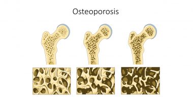 World Osteoporosis Day 2023 Date, Theme & Significance: What Is Osteoporosis? Know More About Building Stronger Bones and Its Awareness