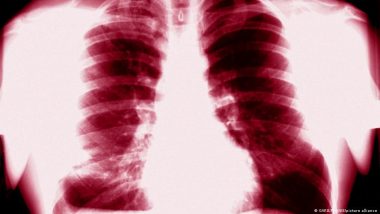 Tuberculosis: First Time Infections Rise to 30-year High