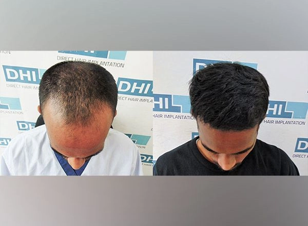 Business News | Exclusive Technique Now Available Only in DHI's Authorized Clinics