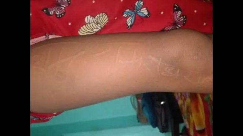 Ram-Ram, Radhe-Radhe: Hindu Deities' Names 'Emerge' on Child's Body in Uttar Pradesh's Hardoi, People Throng to See 'Miracle' (Watch Video)