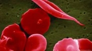 US Approves CRISPR Gene-editing to Treat Sickle Cell Disease