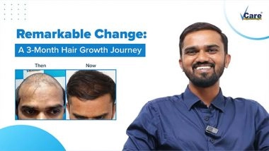Business News | Unlock Your Confidence with VCare's Revolutionary Hair Regrowth Solution!