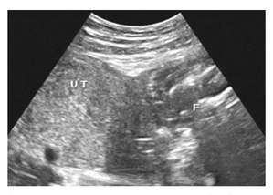Life Saving Operation in BMC Hospital: LTMG Sion Hospital Saves 29-Year-Old Pregnant Woman With Ruptured Uterus Having Dead Baby
