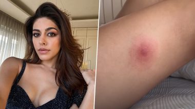 Alaya F Gets Bitten by a Spider Hidden in Her Pants, Reveals Wound in Shocking Snapshot! (View Pic)