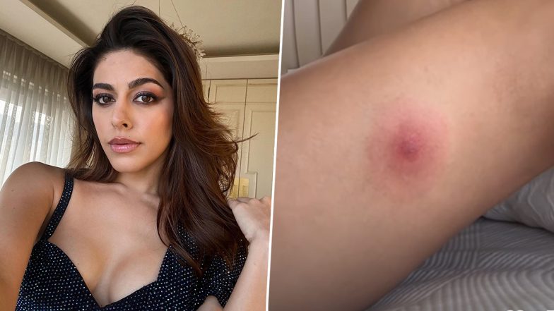 Alaya F Gets Bitten by a Spider Hidden in Her Pants, Reveals Wound in Shocking Snapshot! (View Pic)