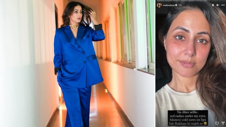 Hina Khan Shares No-Filter Selfie with Rashes and Blisters on Her Lips on Insta Stories, Says, 'Sab Bukhaar Ki Wajeh Se' (See Pic) - Vimarsana News