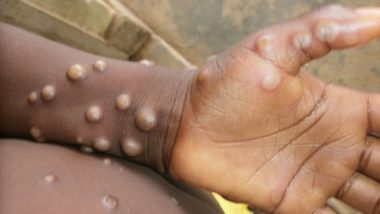 All About New Monkeypox Variant With ‘Pandemic Potential’ Found in Democratic Republic of Congo