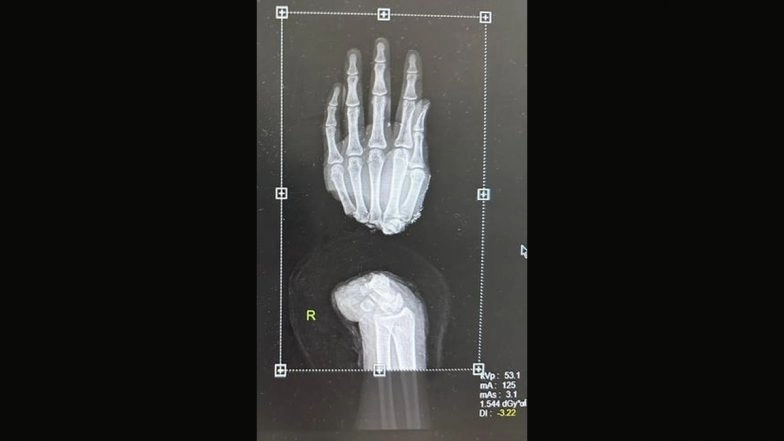 Hand Transplant in Delhi: Doctors at Sir Ganga Ram Hospital Successfully Restore Right Hand of Daily Wage Labourer Who Lost His Limb Due To Accident