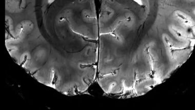 Iseult MRI Scanner: World's Most Powerful MRI Unveiled, Captures Images of Human Brain in Four Minutes; All You Need To Know About Iseult (Watch Video)