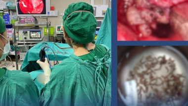 Thailand Medical Horror: Doctors Find Hundreds of Maggots Living Inside Woman's Blocked Nose in Chiang Mai (See Pic)