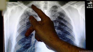 Post-tuberculosis Lung Disease: A Patient and Her Story