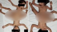 Ischiopagus Tripus Conjoined Twin Boys From Indonesia, Resembling a Spider, Declared Super Rare for Occurring Only Once in Every Two Million Births (View Pic)