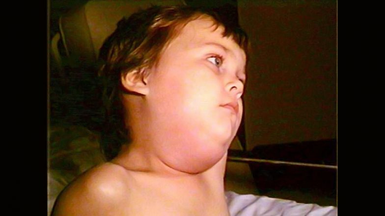 Mumps Virus Causes, Symptoms and Treatment: Everything To Know About the Contagious Viral Infection