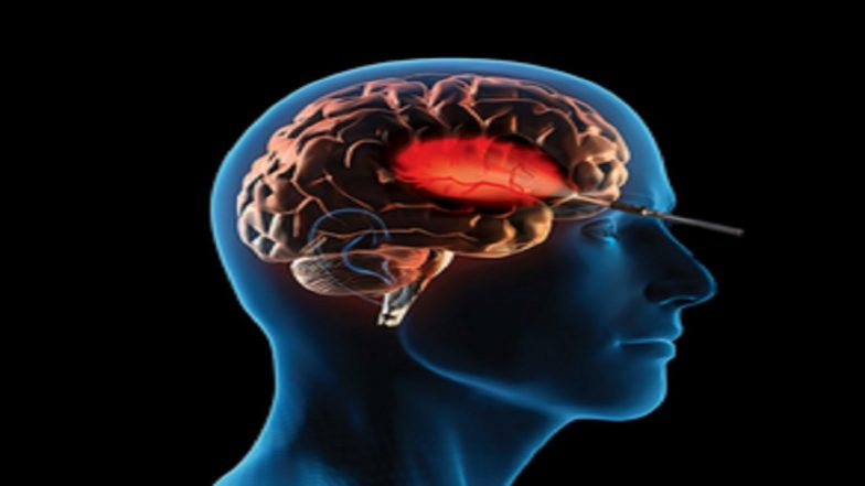 Chennai Doctors Ace World's First Keyhole Surgery For Insular Brain Tumour Via Eyebrow