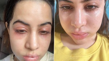 Uorfi Javed Clarifies the Reason Behind Her Swollen Face, Says ‘Fillers Nahi Hai Allergies Hai’ (See Pics)