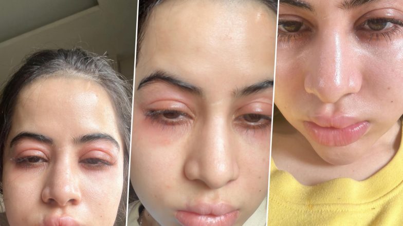 Uorfi Javed Slams Trolls Who Targeted Her for Going Overboard With Botox, Says ’Fillers Nahi Hai, Allergies Hai (See Pics)