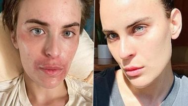 Bruce Willis' Daughter Tallulah Willis Reveals Her Skin-Picking Disorder Journey Via Pics, Celebrates Her Progress