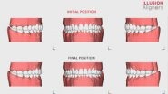Business News | Illusion Aligners Takes the World of Orthodontics by Storm with Advanced 3D Technology