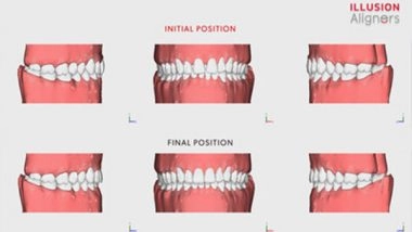Business News | Illusion Aligners Takes the World of Orthodontics by Storm with Advanced 3D Technology