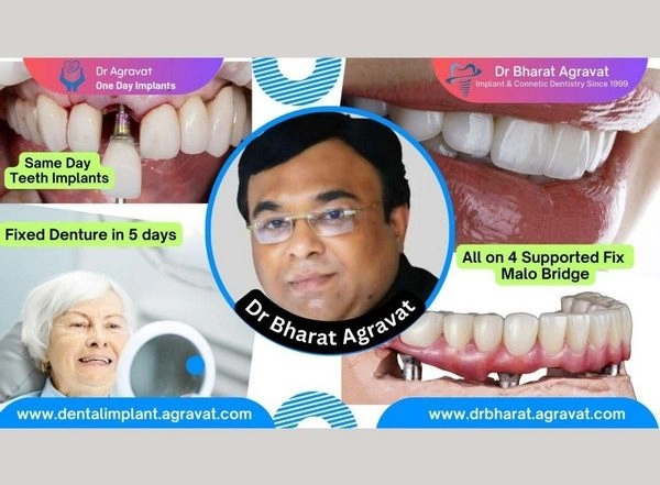 Business News | Best Dentist for Full Mouth Dental Implants Clinic in Ahmedabad: Dr. Bharat Agravat, the Top Implantologist